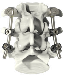 NGMEDICAL ANNOUNCES FIRST IMPLANTATION OF MOVE-P FOR LUMBAR MOTION PRESERVATION